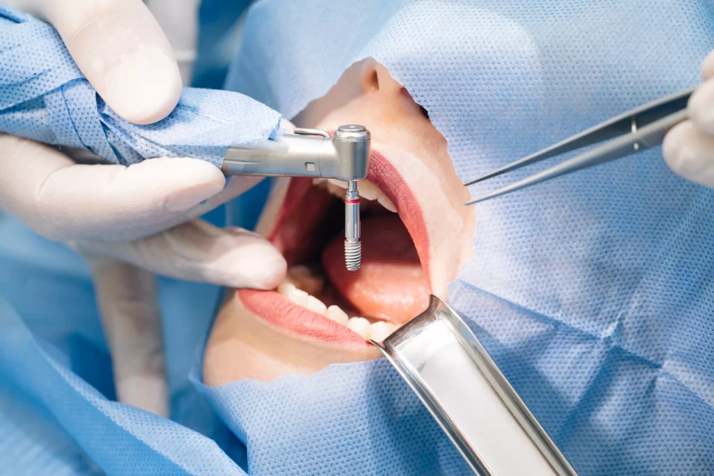Zoom sur une bouche en train de se faire ajouter un implant dentaire